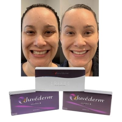 Juvederm Dermal Lip Fillers Hyaluronic Acid ক্রস লিঙ্কড ইনজেকশন