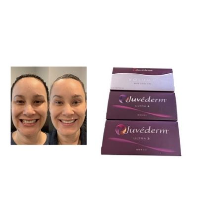 Juvederm ইনজেকশনযোগ্য ত্বকের ফিলার Juvederm Ultra3 Ultra4 Voluma